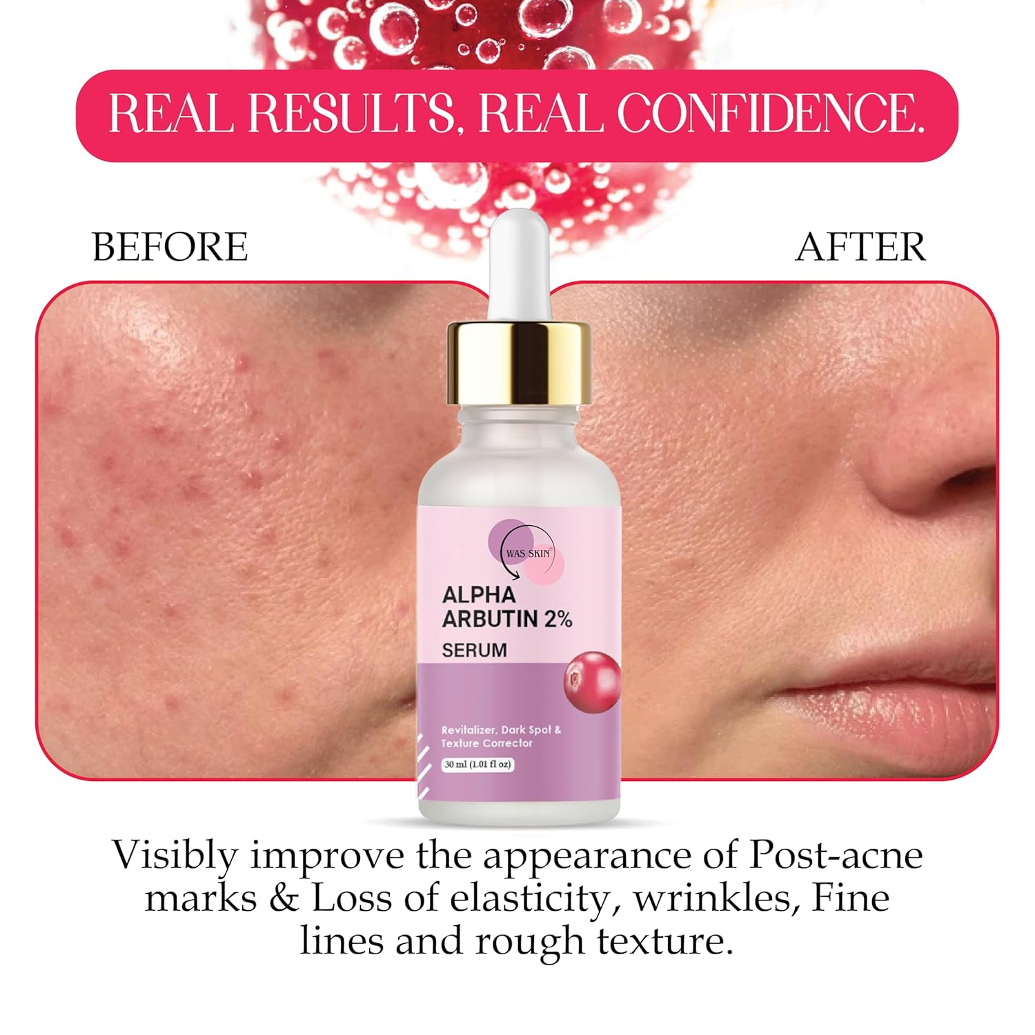 WAS SKIN Alpha Arbutin 2% Serum with Hyaluronic Acid, Dark Spot and Texture Corrector, Revitaliser, 30 ml